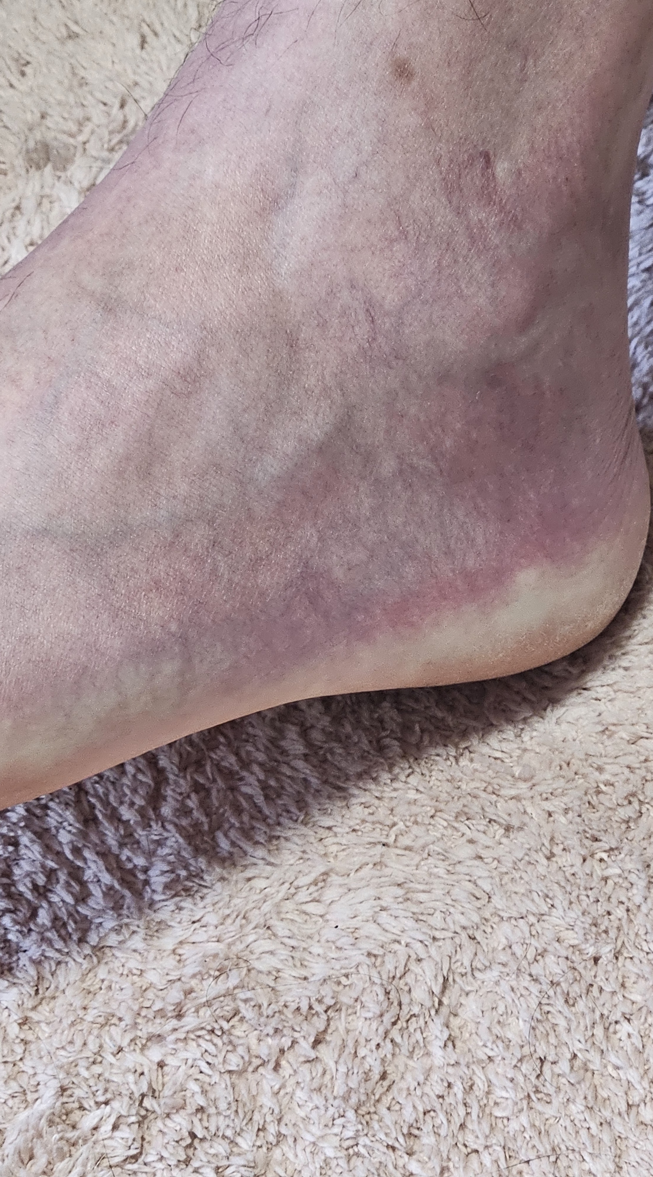eerste paarse verkleuring van de voet , violet naar donker paars